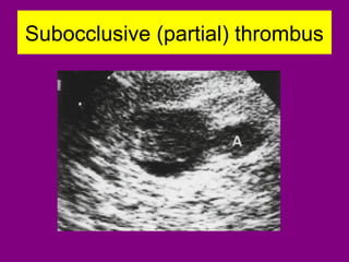 Subocclusive (partial) thrombus
 