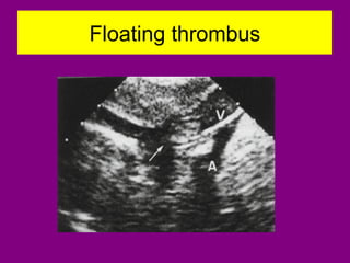 Floating thrombus
 