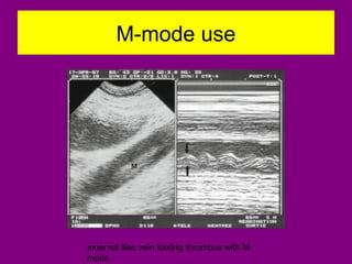 M-mode use
external iliac vein foating thrombus with M-
mode
 