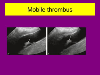 Mobile thrombus
 