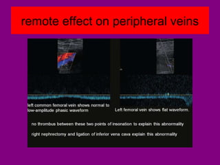 remote effect on peripheral veins
 