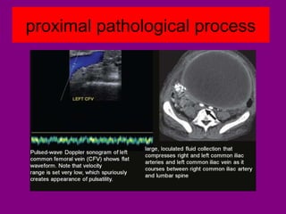 proximal pathological process
 