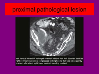 proximal pathological lesion
 