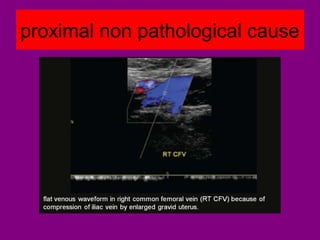 proximal non pathological cause
 