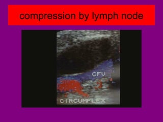 compression by lymph node
 