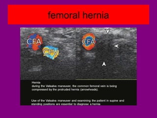 femoral hernia
 