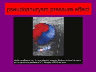 pseudoanurysm pressure effect
 