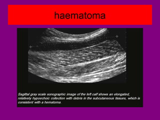 haematoma
 