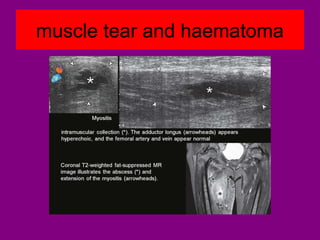 muscle tear and haematoma
 