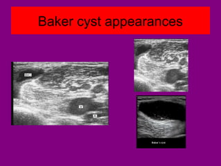 Baker cyst appearances
 