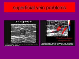 superficial vein problems
 