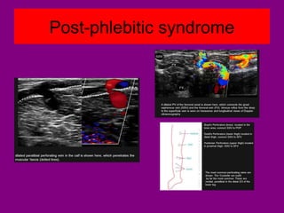 Post-phlebitic syndrome
 