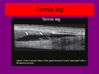Tennis leg
 