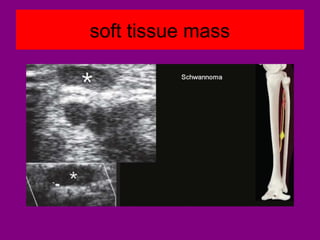soft tissue mass
 