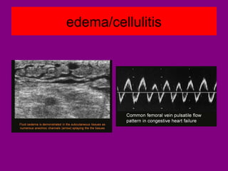 edema/cellulitis
 
