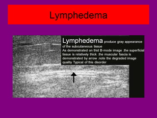 Lymphedema
 