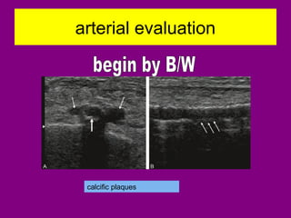 arterial evaluation
calcific plaques
 