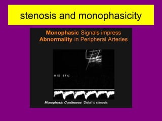 stenosis and monophasicity
 