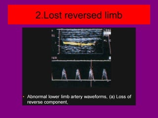 2.Lost reversed limb
 