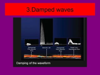 3.Damped waves
 