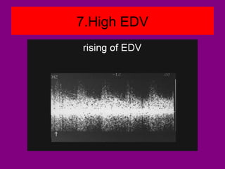7.High EDV
 