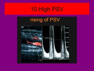 10.High PSV
 