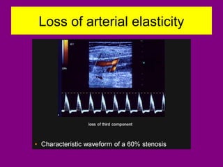 Loss of arterial elasticity
 