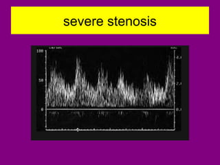 severe stenosis
 