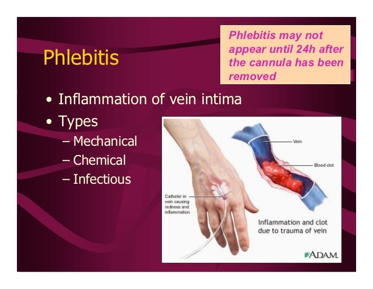 Peripheral IV Therapy