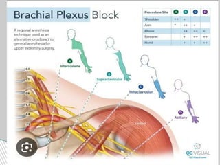peripheral nerve block DHARMARAJ 123.pdf