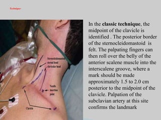 Technique-
In the classic technique, the
midpoint of the clavicle is
identified . The posterior border
of the sternocleidomastoid is
felt. The palpating fingers can
then roll over the belly of the
anterior scalene muscle into the
interscalene groove, where a
mark should be made
approximately 1.5 to 2.0 cm
posterior to the midpoint of the
clavicle. Palpation of the
subclavian artery at this site
confirms the landmark
 
