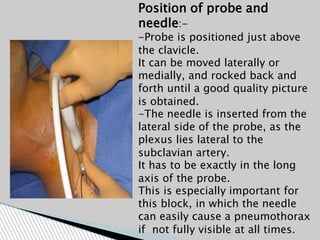 Position of probe and
needle:-
-Probe is positioned just above
the clavicle.
It can be moved laterally or
medially, and rocked back and
forth until a good quality picture
is obtained.
-The needle is inserted from the
lateral side of the probe, as the
plexus lies lateral to the
subclavian artery.
It has to be exactly in the long
axis of the probe.
This is especially important for
this block, in which the needle
can easily cause a pneumothorax
if not fully visible at all times.
 