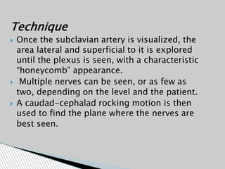 Technique
 Once the subclavian artery is visualized, the
area lateral and superficial to it is explored
until the plexus is seen, with a characteristic
“honeycomb” appearance.
 Multiple nerves can be seen, or as few as
two, depending on the level and the patient.
 A caudad-cephalad rocking motion is then
used to find the plane where the nerves are
best seen.
 