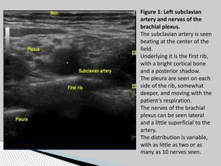 Figure 1: Left subclavian
artery and nerves of the
brachial plexus.
The subclavian artery is seen
beating at the center of the
field.
Underlying it is the first rib,
with a bright cortical bone
and a posterior shadow.
The pleura are seen on each
side of the rib, somewhat
deeper, and moving with the
patient’s respiration.
The nerves of the brachial
plexus can be seen lateral
and a little superficial to the
artery.
The distribution is variable,
with as little as two or as
many as 10 nerves seen.
 