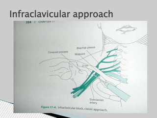 Infraclavicular approach
 