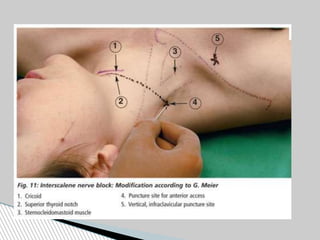 peripheral nerve block DHARMARAJ 123.pdf