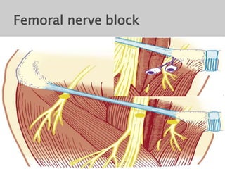 Femoral nerve block
 