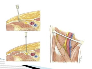 peripheral nerve block DHARMARAJ 123.pdf