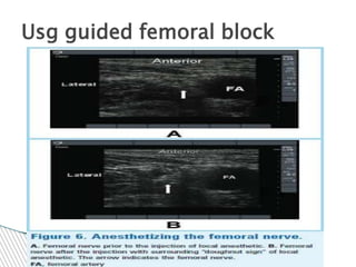Usg guided femoral block
 
