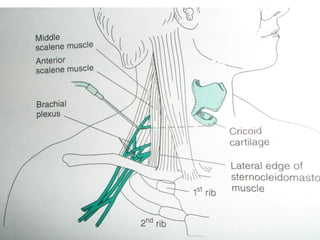 PERIPHERAL NERVE BLOCK IN UPPER LIMB SURGERIES.pptx