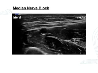 PERIPHERAL NERVE BLOCK IN UPPER LIMB SURGERIES.pptx