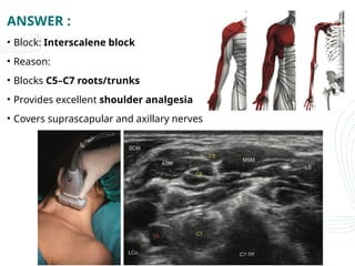 Nerve Block Example PERIPHERAL NERVE BLOCK IN UPPER LIMB SURGERIES.pptx