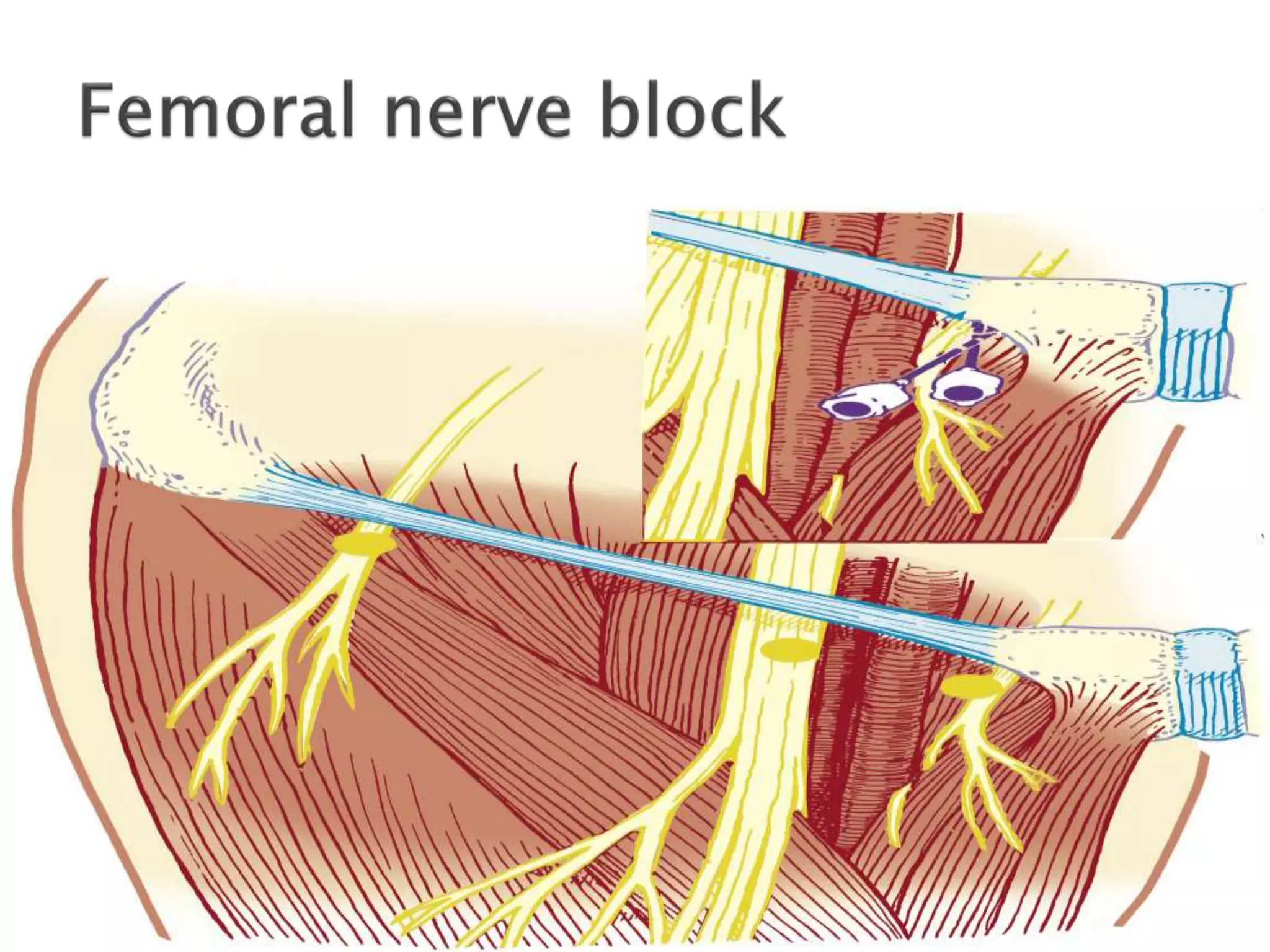 Peripheral nerve blocks | PPTX