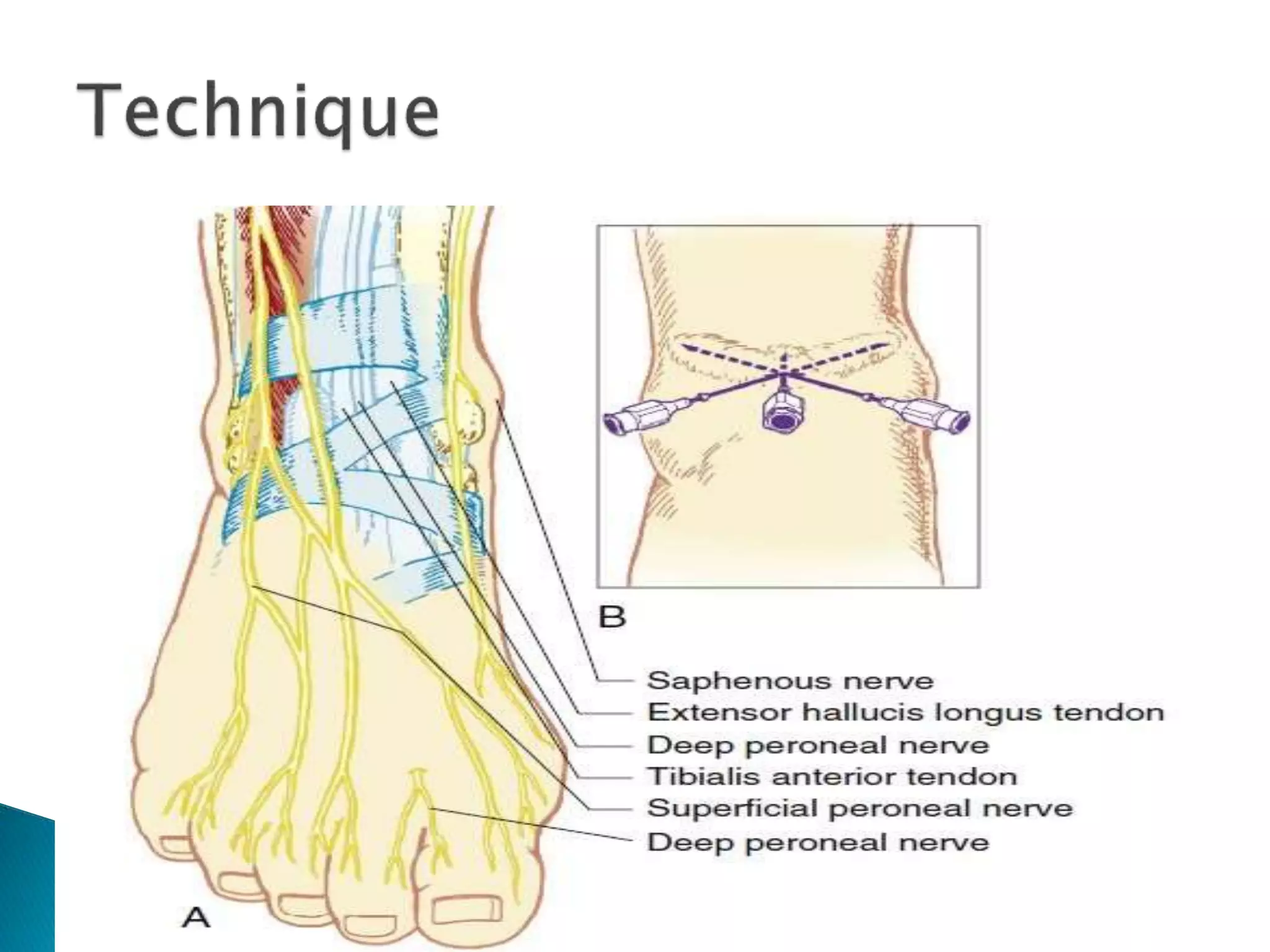 Nerve Block Example Peripheral nerve blocks | PPTX