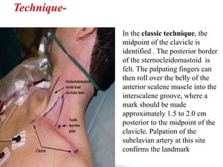 In the classic technique, the
midpoint of the clavicle is
identified . The posterior border
of the sternocleidomastoid is
felt. The palpating fingers can
then roll over the belly of the
anterior scalene muscle into the
interscalene groove, where a
mark should be made
approximately 1.5 to 2.0 cm
posterior to the midpoint of the
clavicle. Palpation of the
subclavian artery at this site
confirms the landmark
 
