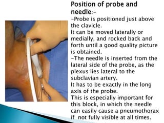 Position of probe and
needle:-
-Probe is positioned just above
the clavicle.
It can be moved laterally or
medially, and rocked back and
forth until a good quality picture
is obtained.
-The needle is inserted from the
lateral side of the probe, as the
plexus lies lateral to the
subclavian artery.
It has to be exactly in the long
axis of the probe.
This is especially important for
this block, in which the needle
can easily cause a pneumothorax
if not fully visible at all times.
 