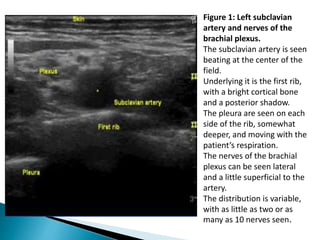 Figure 1: Left subclavian
artery and nerves of the
brachial plexus.
The subclavian artery is seen
beating at the center of the
field.
Underlying it is the first rib,
with a bright cortical bone
and a posterior shadow.
The pleura are seen on each
side of the rib, somewhat
deeper, and moving with the
patient’s respiration.
The nerves of the brachial
plexus can be seen lateral
and a little superficial to the
artery.
The distribution is variable,
with as little as two or as
many as 10 nerves seen.
 