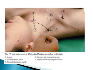 Peripheral nerve blocks