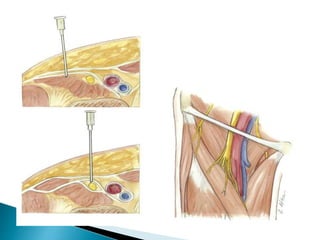 Peripheral nerve blocks
