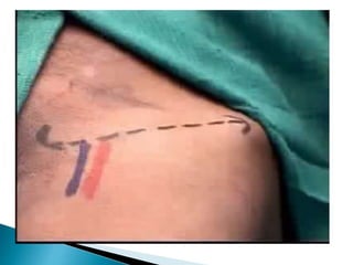 Peripheral nerve blocks